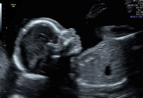 Elite Ultrasound Gender Scan