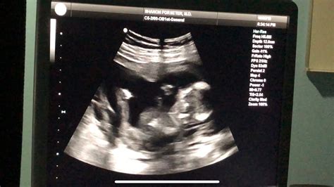 16w1d ultrasound gender revealed youtube