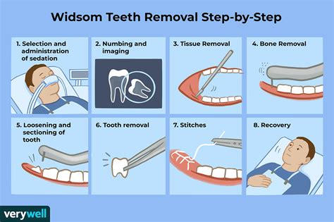 wisdom teeth removal surgery preparation  recovery
