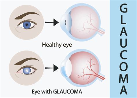glaucoma   contact lens wearers    perfectlens canada