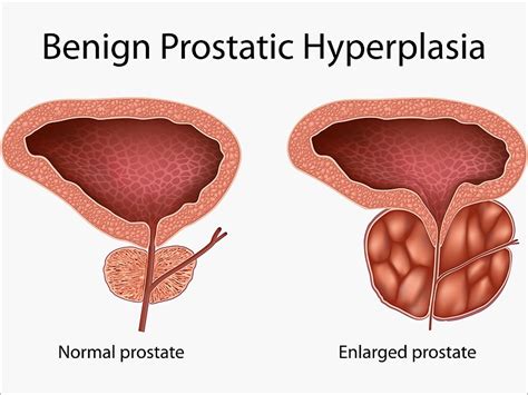 Prostate Artery Embolization Safe For Benign Hyperplasia