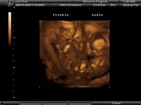boy girl twins  ultrasound  weeks  days
