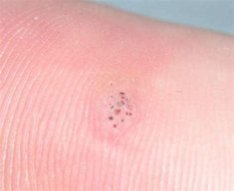 foot blister treatment webmd wart removal on palm of hand dr scholls