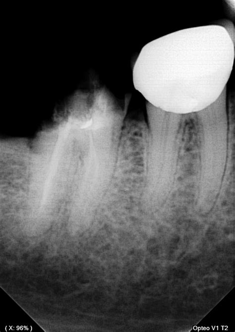 painless  implant  molar treatment  broken molar