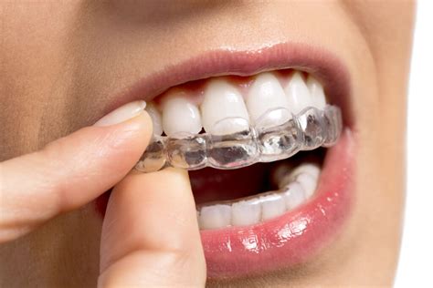 orthodontics australia clear aligner attachments    work