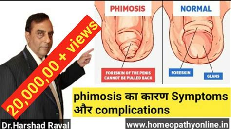 Phimosis का बिना ऑपरेशन के इलाज Best Treatment For Phomosis L