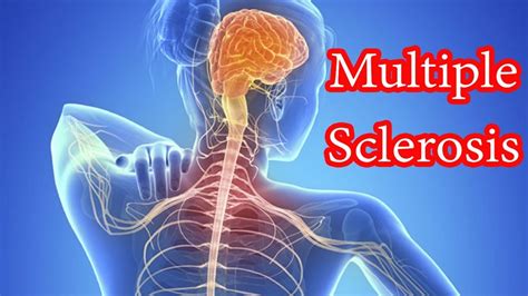 multiple sclerosis affects daily life miosuperhealth