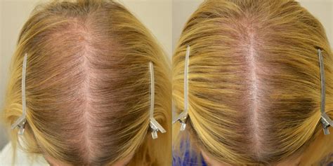 topical minoxidil females before and after photos hair restoration of