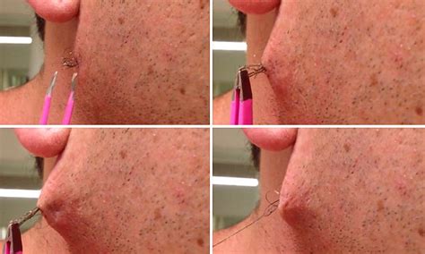 man pulls world s longest ingrown hair out of his face