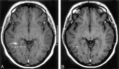 Mr Imaging Of Relapsing Multiple Sclerosis Patients Using Ultra Small