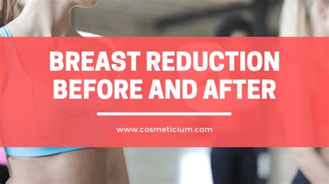 breast reduction    cosmetic surgery cosmeticium