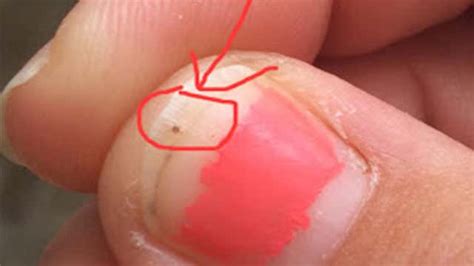 Mom Shares Shocking Photos Of 3 Year Old S Seed Tick Bites To Raise