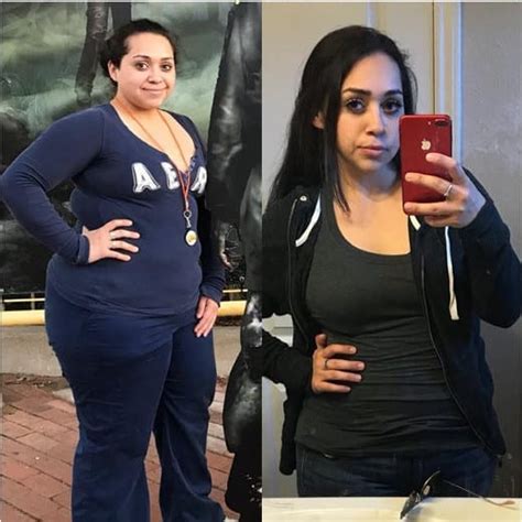 Roux En Y Gastric Bypass In Tijuana Mexico Starting At 5 995