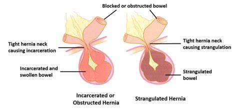 hernias hernia surgery suny upstate