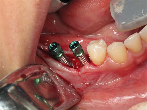 computer guided dental implant surgery  burbank la ramsey  amin