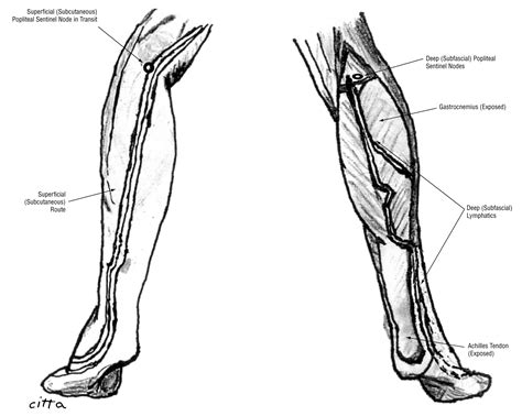 lymphatic drainage to the popliteal basin in distal lower extremity