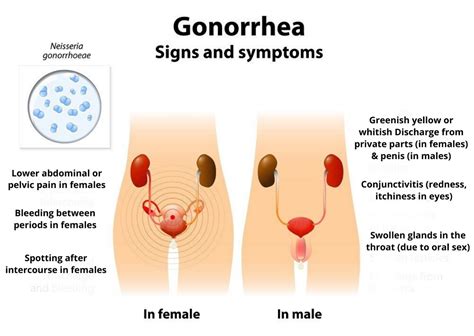 How To Detect Gonorrhea Phaseisland17