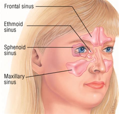 sinusitis   lowering  painful infection hubpages