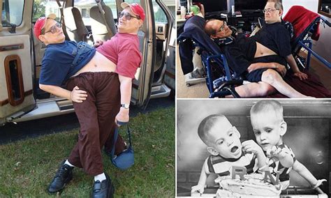 ronnie and donnie galyon surpass world record for longest living conjoined twins daily mail online