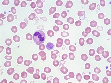 sideroblastic anemia a laboratory guide to clinical
