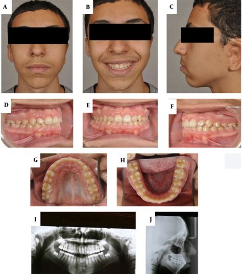 extraoral  intraoral post treatment photographs panoramic view