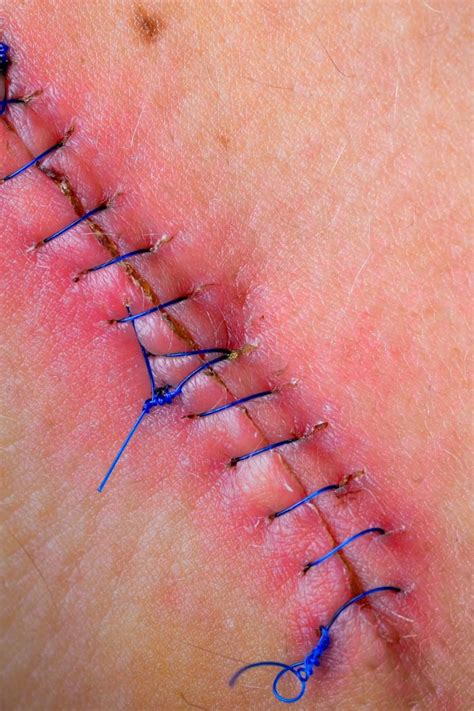 remove stitches safely  home
