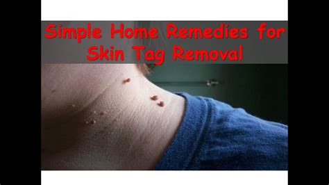 best natural home remedies to remove skin tags simple remedies for