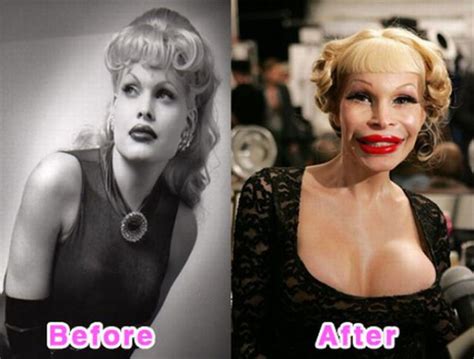 celebrity plastic surgery before and after photos 16 pics