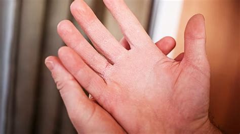 remedies  treat dry hands onlymyhealth