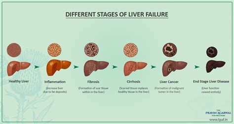 early symptoms  cirrhosis   liver information variuos