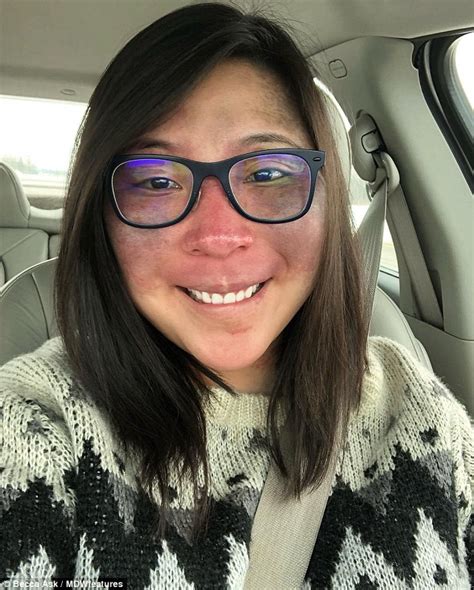 Minnesota Woman Who Hid Her Birthmarks Shows Off Her Natural Face