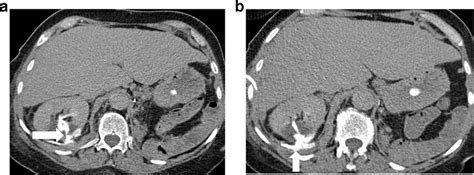 A Axial Contrast Enhanced Ct During Delay Excretory Phase Showed