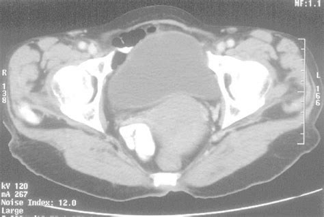 transverse section of ct scan showing enlarged uterus with enhancing