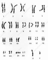 Karyotype Syndrome Down Chromosomes Genetics Downs Photograph Anglian Regional East Service Features sketch template