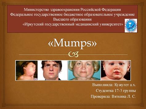 mumps etiology