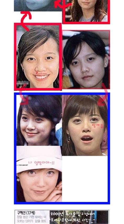 Hey Hey Hey [ Koo Hye Sun ] Before And After Plastic Surgery