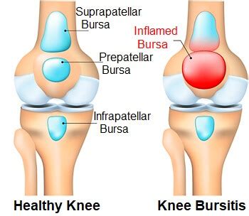 knee bursitis symptoms diagnosis treatment