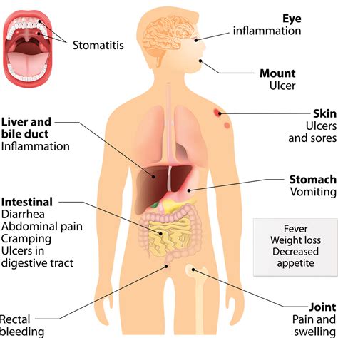 crohn s disease alfred gastroeneterology
