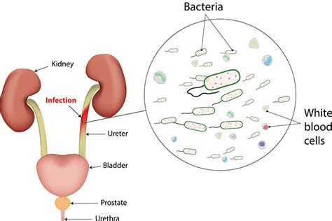 An Overview Of Urinary Tract Infection Uti Urology Specialist