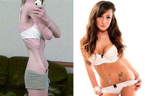 Anorexic Girl Who Plummeted To Four Stone Overcomes Eating Disorder To