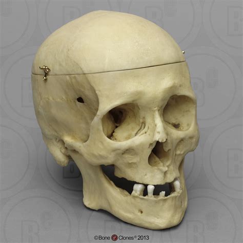 Human Male Skull 22 Caliber Bullet Wound With Calvarium