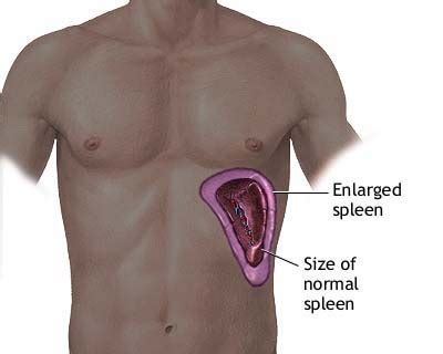 enlarged spleen symptoms  treatment pictures functions