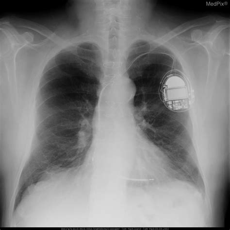 artificial pacemaker wikidoc