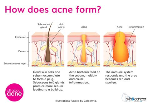 What Causes Acne Acne Causes All About Acne