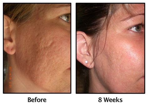 client   amp md roller  diminish acne scarring incredible visit hopecas