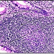 Bildergebnis für B-zelliges Nhl des Ileums Vom Typ eines Sporadischen Burkitt-Lymphoms. Größe: 187 x 136. Quelle: tales.nmc.unibas.ch