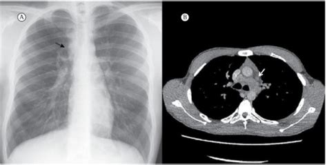 A Chest X Ray Posteroanterior View Showing A Widene Open I