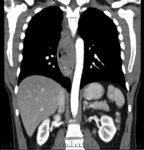 Extensive Mediastinal Lymphadenopathy On Staging Ct Scan Download