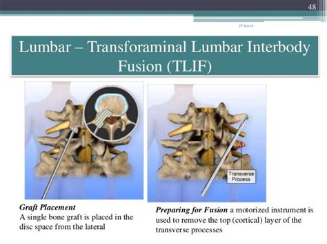 Lumbar Interbody Fusion Indications Techniques And Complications