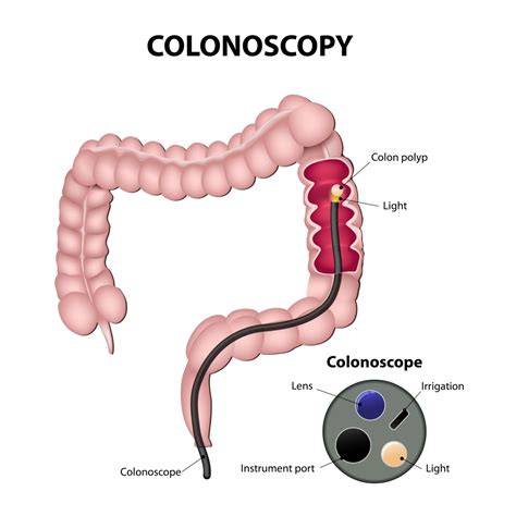 Colonoscopy What To Expect Gastroenterology Health Partners